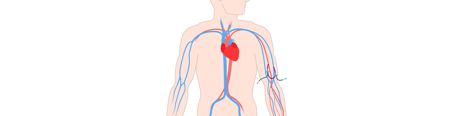 Hemodialysis Vascular Center